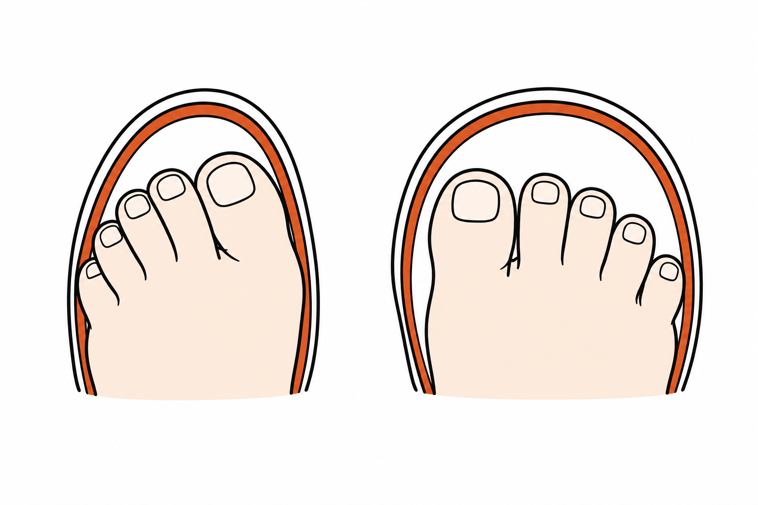 Comparison of a narrow toe box with squeezed toes and a wide toe box with naturally spread toes
